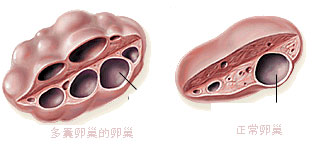 多囊不孕原因到底是什么？分型诊疗摆脱多囊困扰