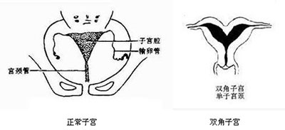 双角子宫是什么？该如何治疗