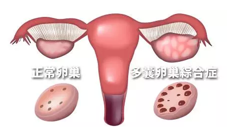 多囊卵巢综合症为何要进行内分泌检查