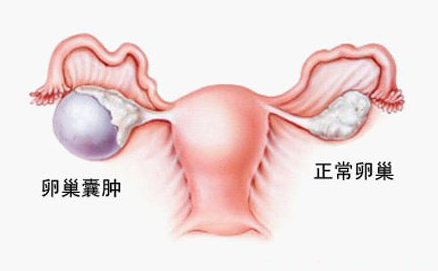 卵巢囊肿有哪些辅助检查