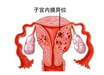 怎样预防子宫内膜异位症