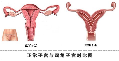 双角子宫怎么治疗好？