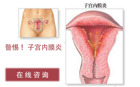 子宫内膜炎有哪些危害