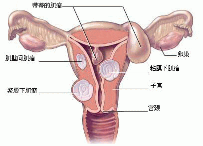 有子宫肌瘤要如何检查呢