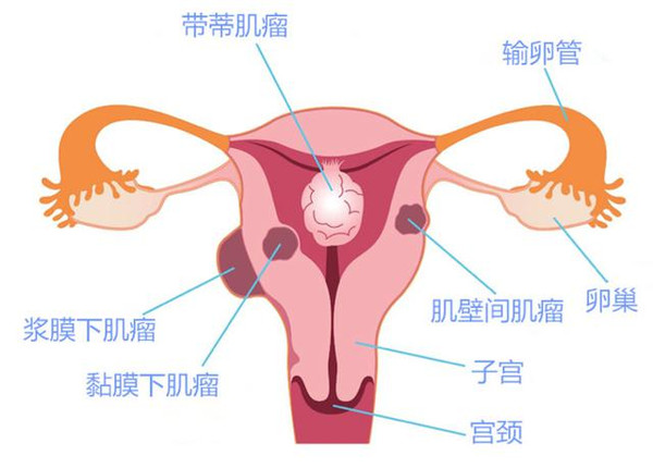 女性得了子宫肌瘤怎么治?